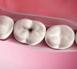 Scellant dentaire